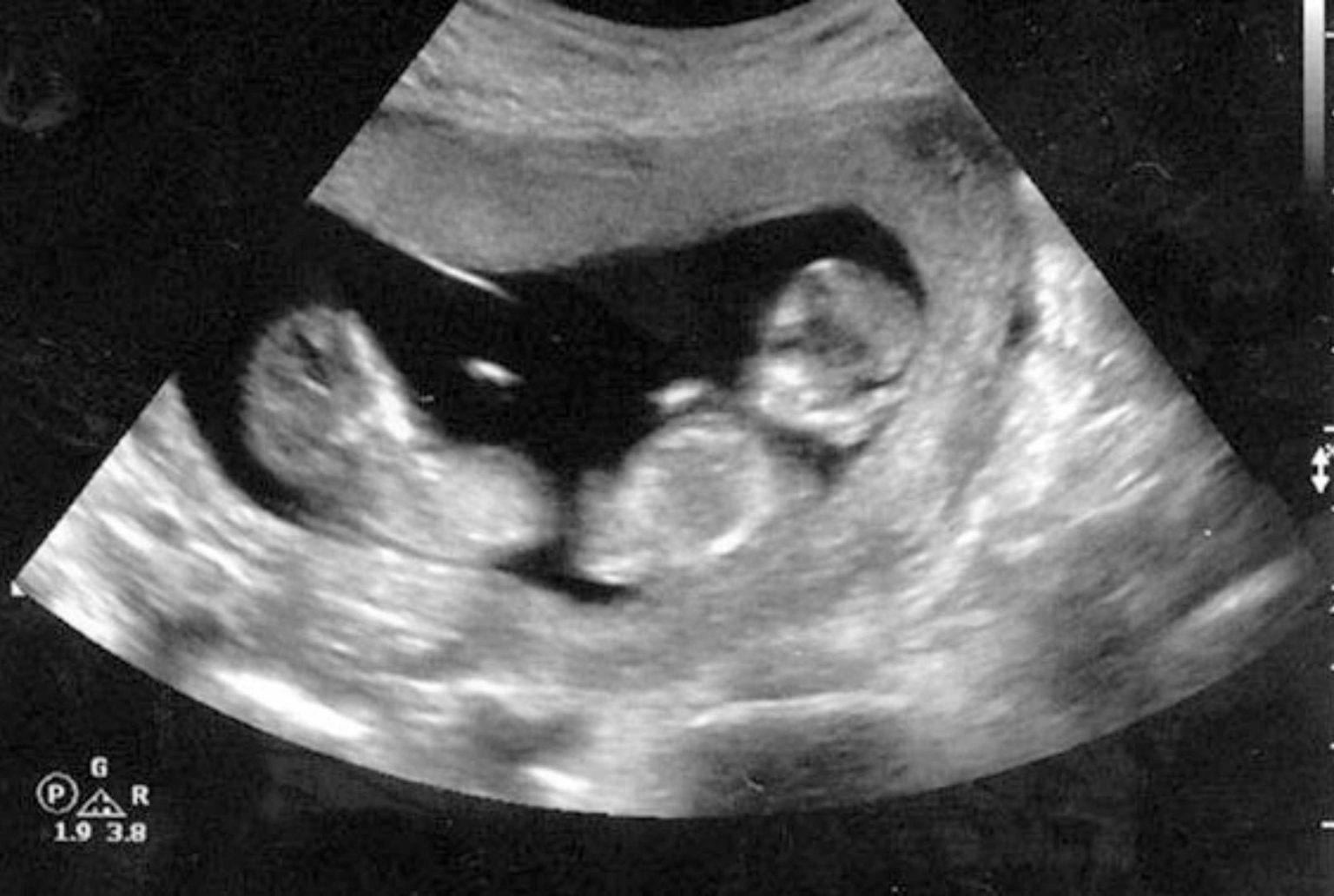 Шевеления на 12 неделе. Двойняшки на УЗИ 12 недель беременности. УЗИ 12 недель беременности двойня. УЗИ близнецов на 12 неделе беременности. Монохориальная двойня УЗИ.